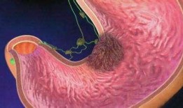 縻烂性胃炎可以吃老鼠瓜,老鼠瓜助力康复之旅